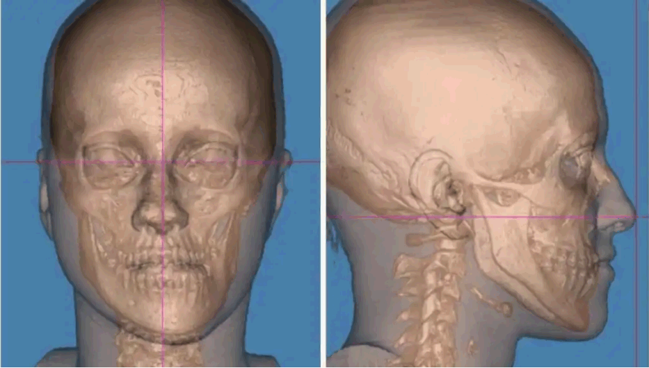 La nueva cirugía española que corrige anomalías de mandíbula y rostro: “La simetría es importante”